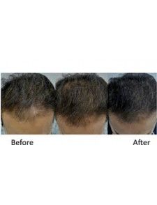 XTRA HAIR RESTORER MESOTHERAPY