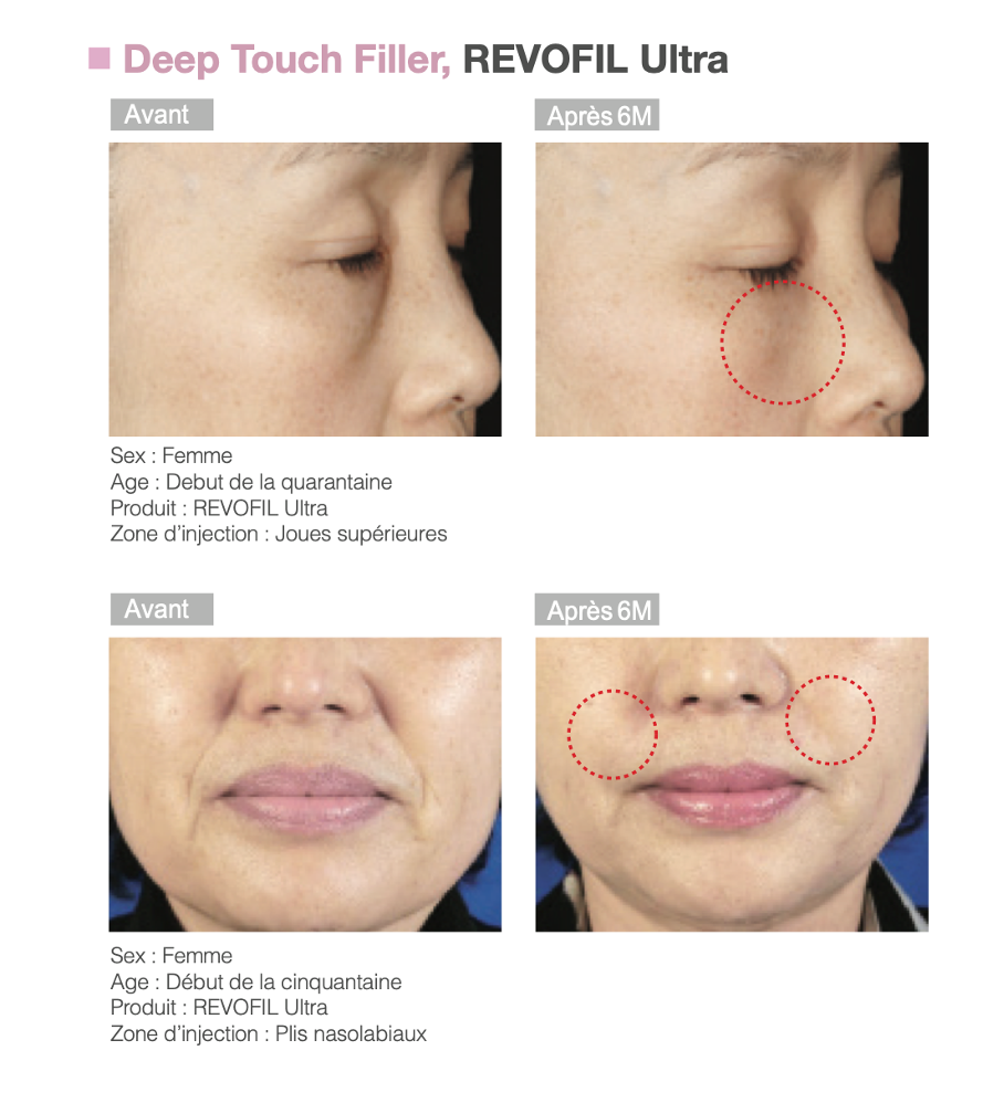 Revofil Ultra Before after