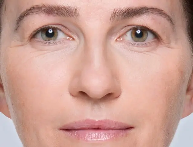 Après injection Restylane eyelight cernes