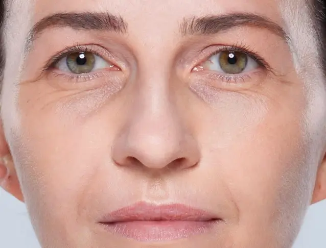 Restylane eyesight injection cernes avant