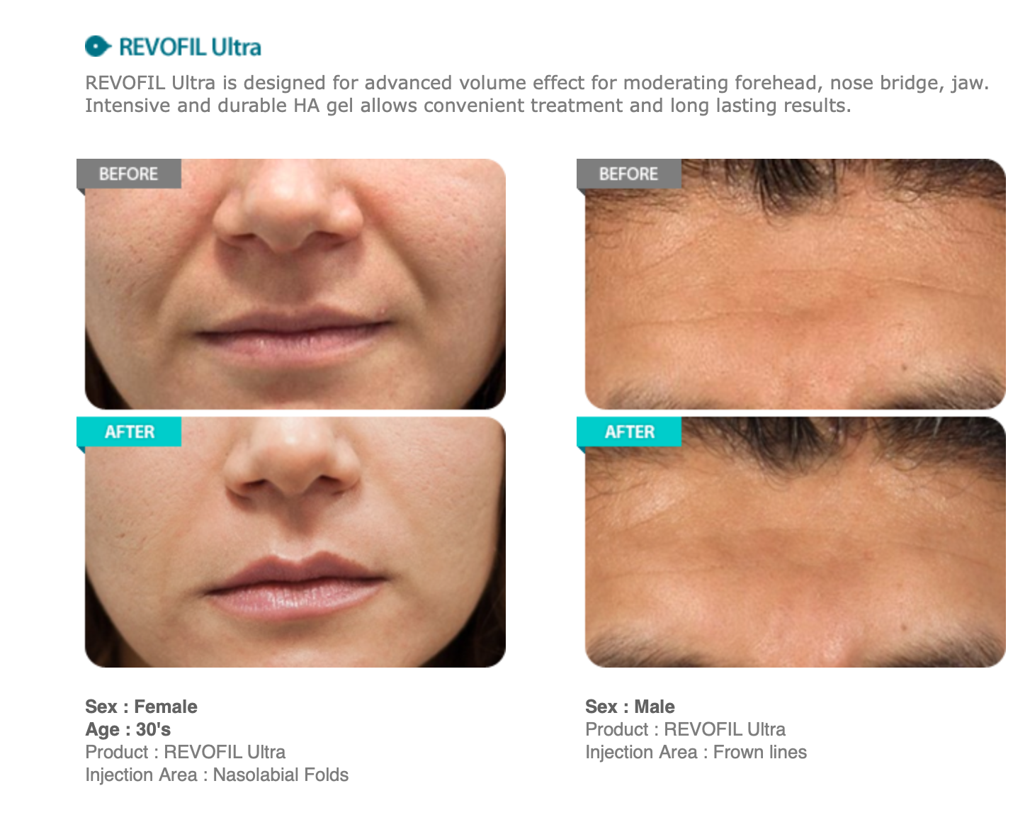 Revofil ultra injections acheter