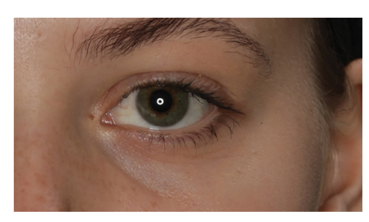 cerne galderma restylane eyelight traitement cernes poches injections
