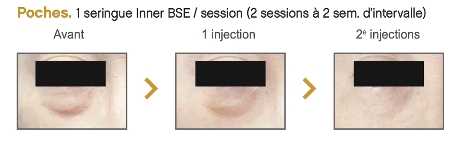 prostrolane Inner B SE injections